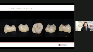 モノリシックジルコニアレストレーション シエン社 | モノリシックジルコニアレストレーション